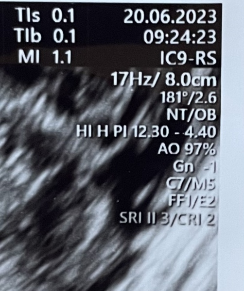 No heartbeat 