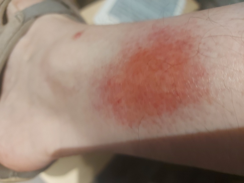 (Maybe?) Nasty bite?