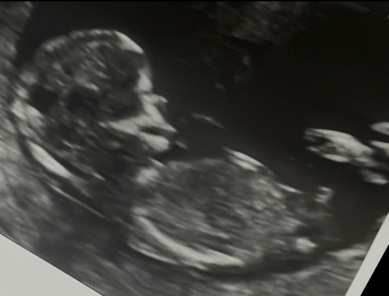 Nub theory - please guess my baby's gender!