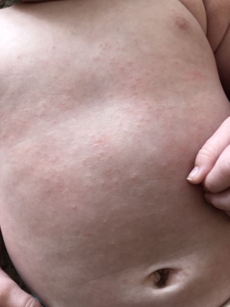 Is this heat rash / prickly heat?