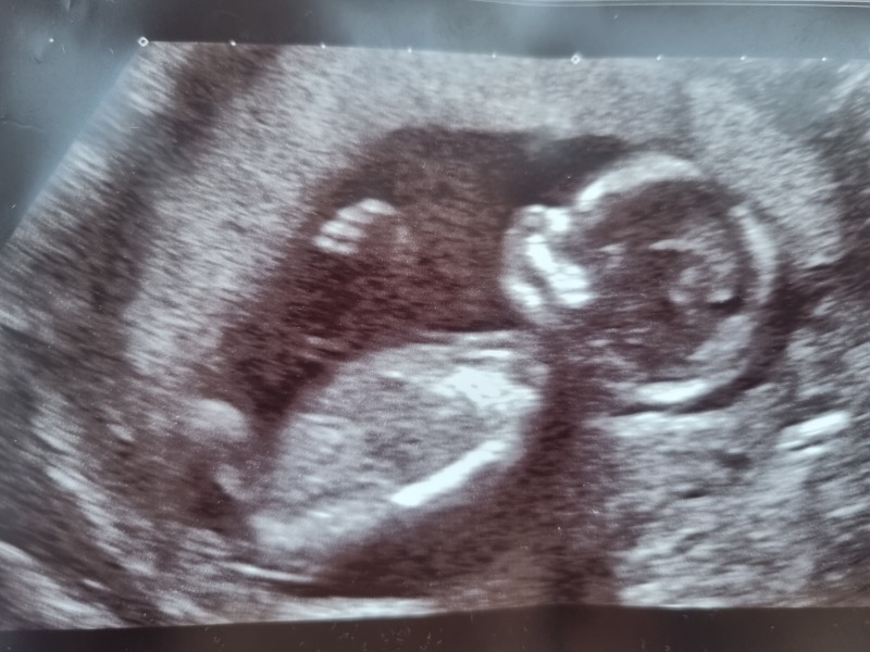 Babys size on scan