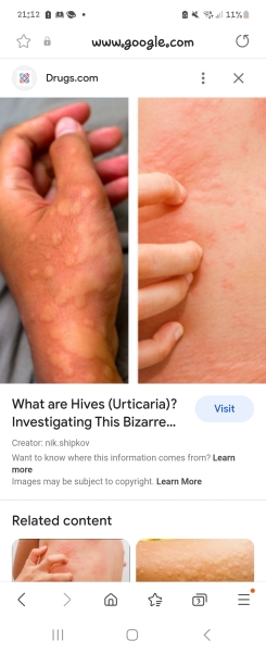 Hives are driving me insane 