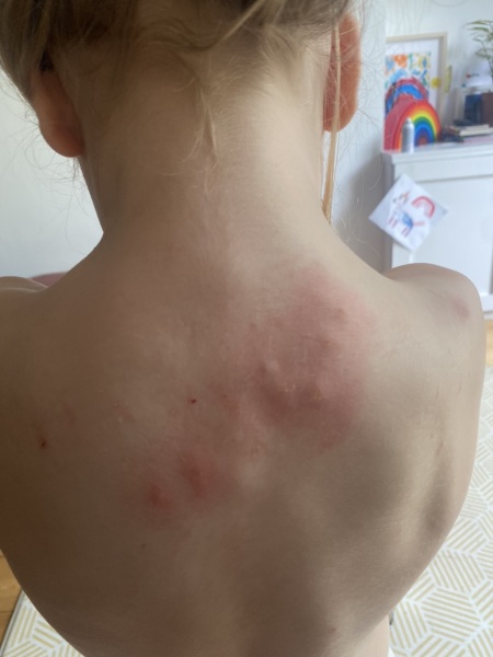 What sort of bites are these?