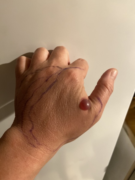 Bite, red/purple blister and swelling/nurses 