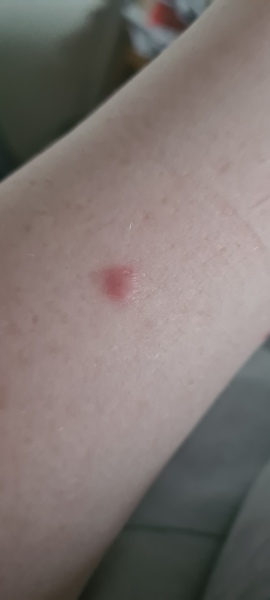 Ingrowing hair cyst?
