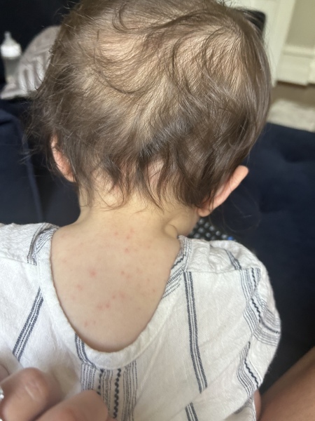 Chicken pox???
