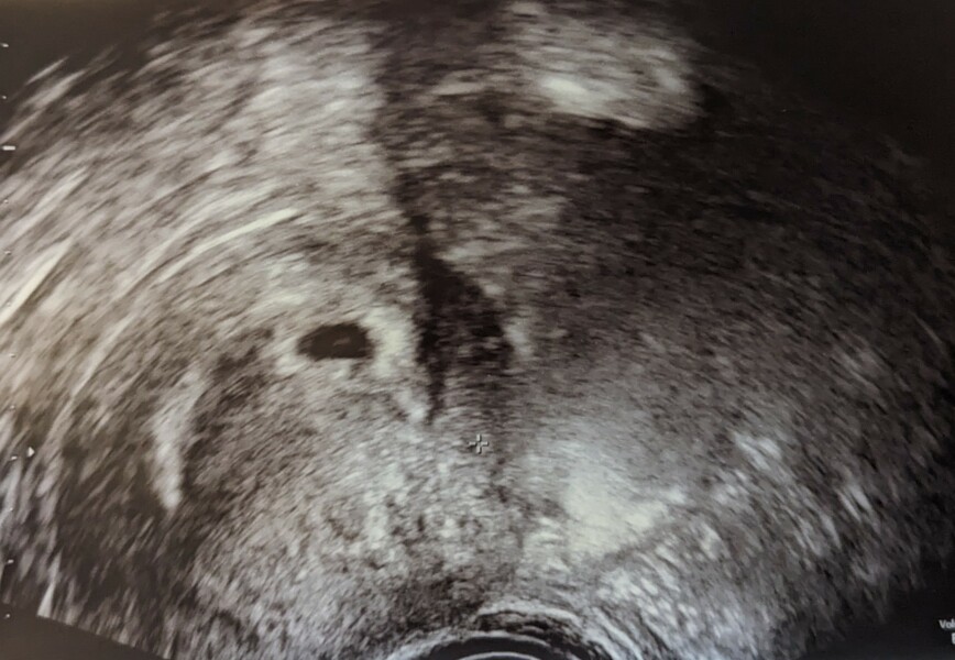 First scan after FET with a PGT embryo