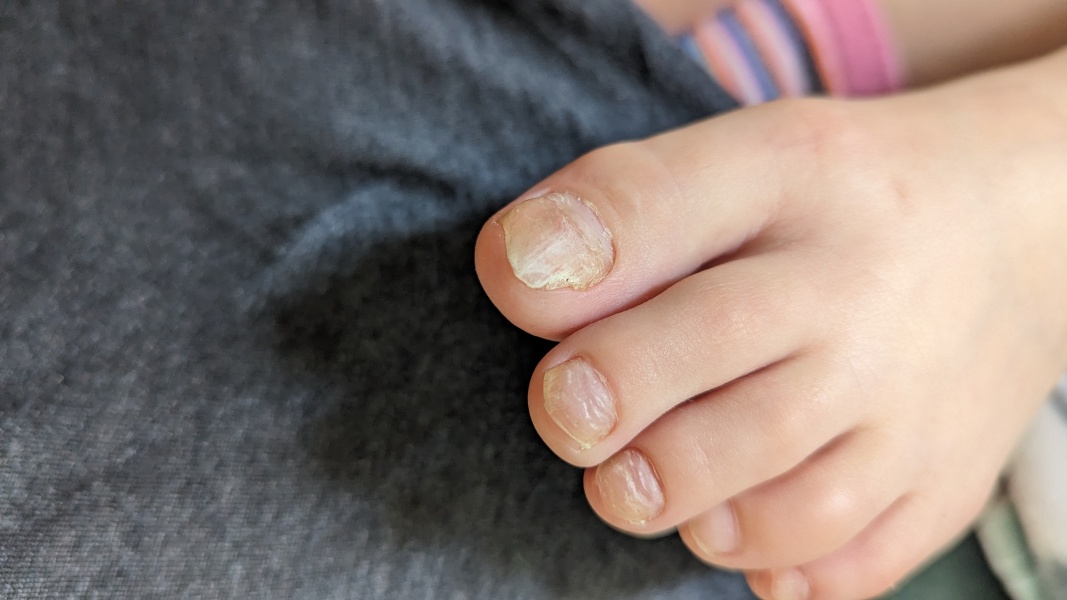 Fungal toenails, 8yo