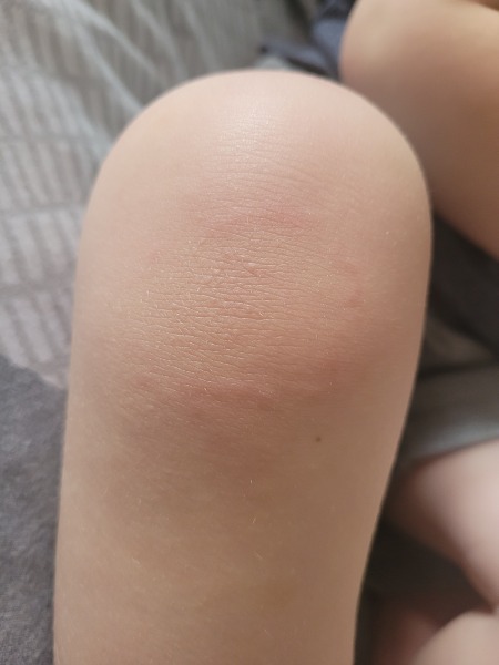 Opinions on (?)rash