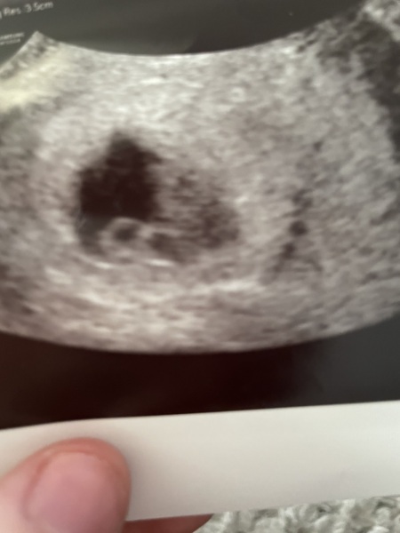 Two circles early ultrasound