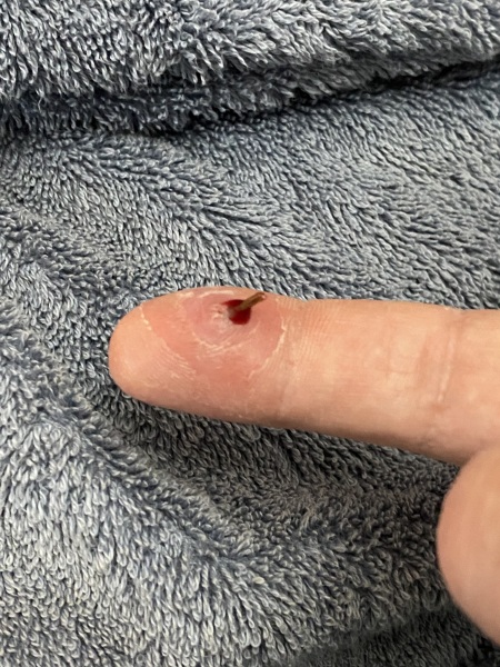 Bamboo splinter- the results are in (with photos)