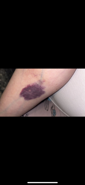 Bruising