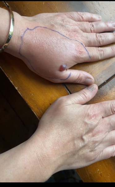Bite, red/purple blister and swelling/nurses 
