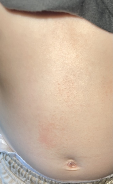 Stubborn rash 