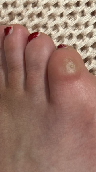 What's this on my toe?! Gross pic