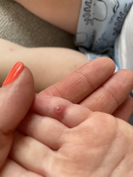 Chicken Pox pictures