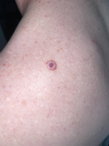 Mole with ring around it 