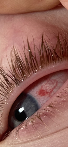 Blood shot eye from pencil