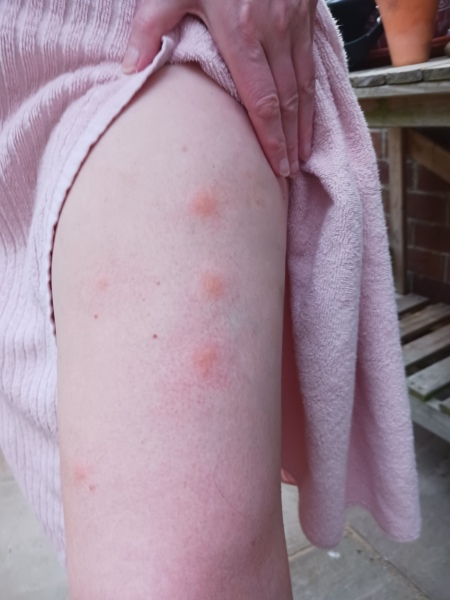 Anyone know how to relieve the itching from these bites?