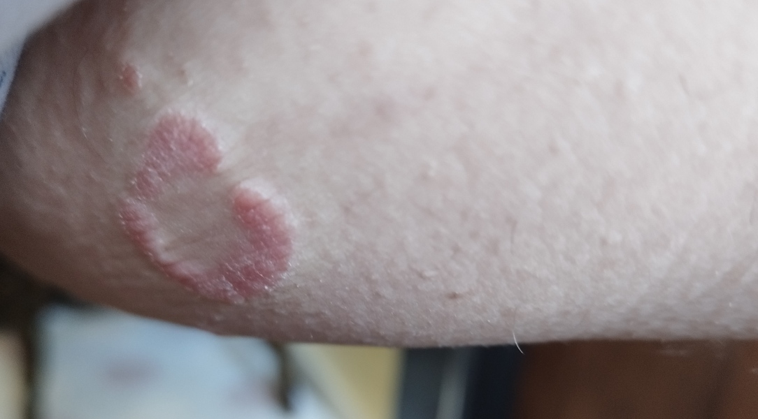 Any idea what this rash is on inside leg