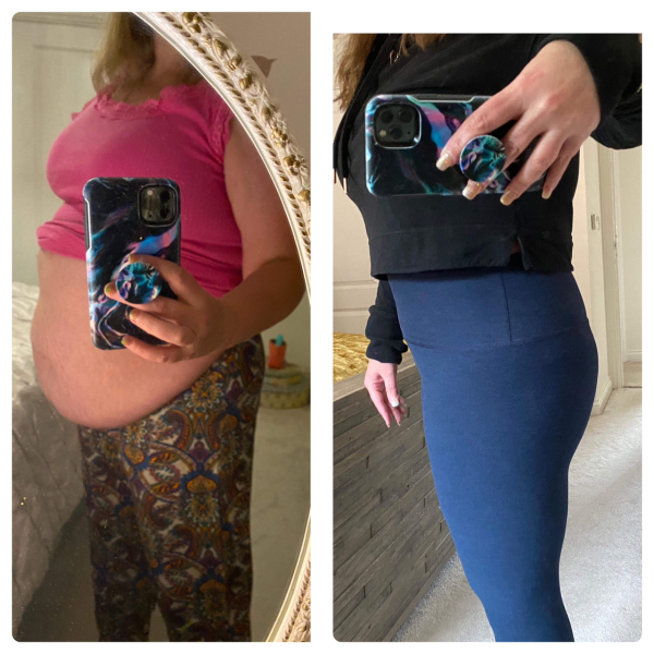 Tummy Tuck consultation
