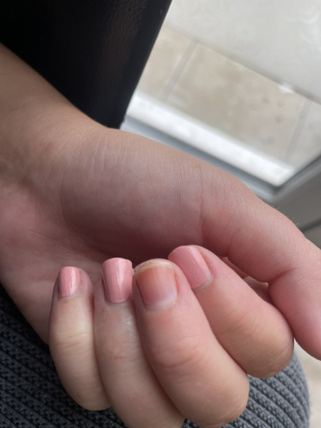 Melanoma scare advice please