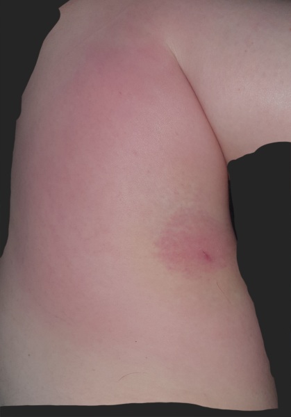 Would you be concerned by this bite?