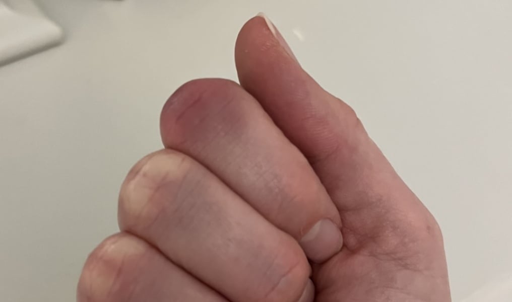 Achenbach syndrome - help, please!