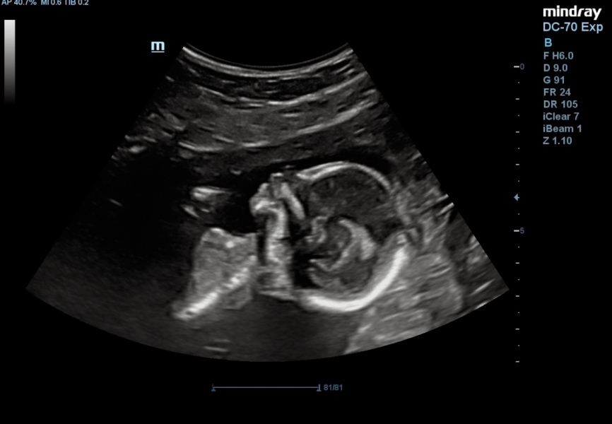 First cycle - IVF / ICSI - Day 4 