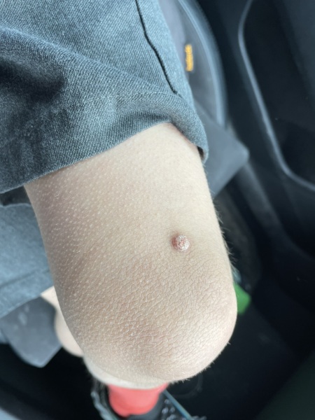 Wart (picture added)