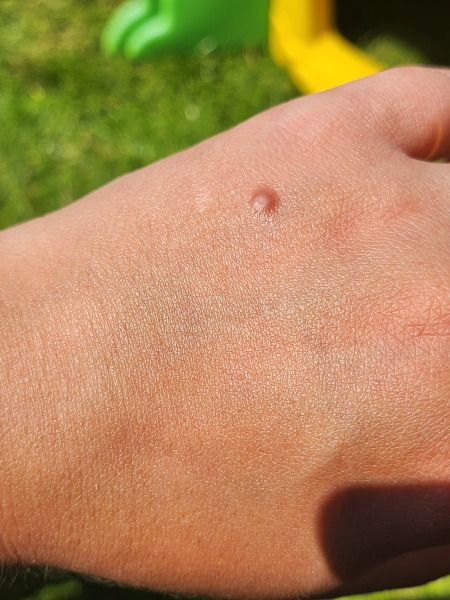 Mole on hand