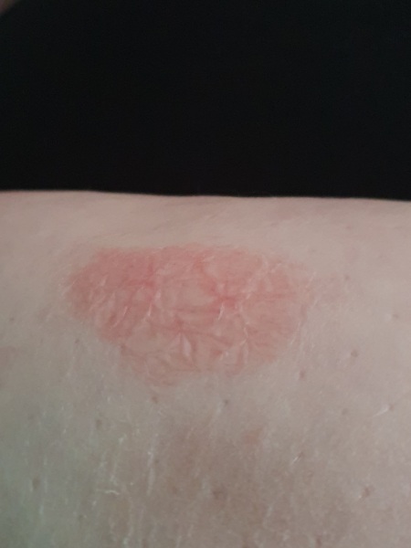 Lubion - Red, scaly patch