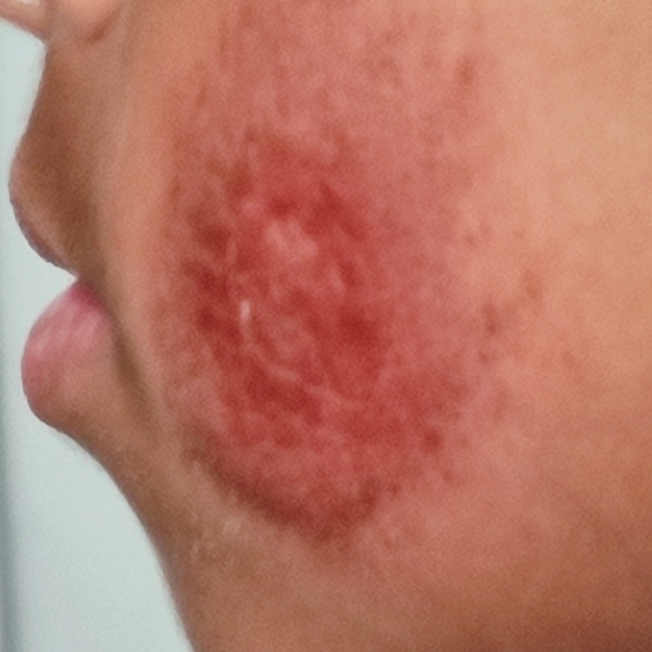 What can I put on skin - bad fall (gross pic alert) 