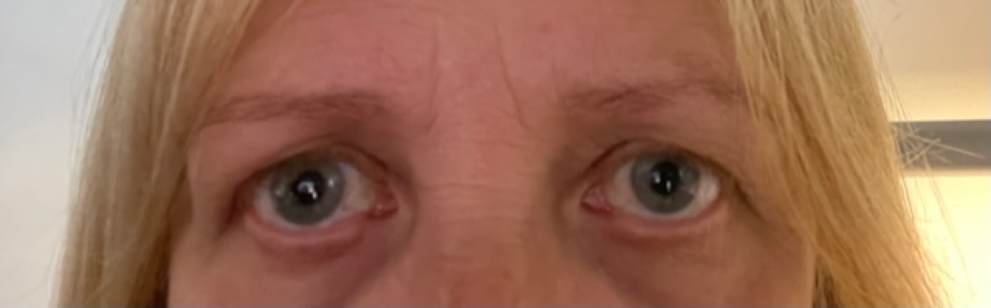 Upper Blepheroplasty