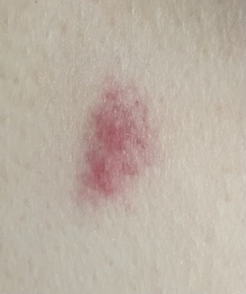 What bit me?