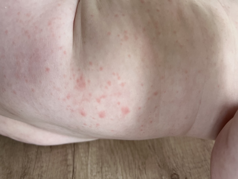 Baby rash not fading on glass test 