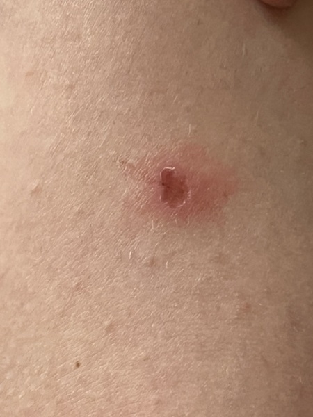Odd circular wounds on limbs - bites??