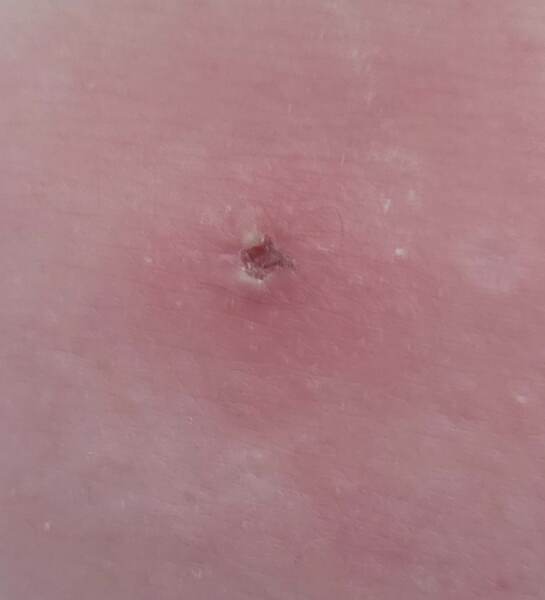 Crater-like wound on my leg turning black - what the hell is this (see pic)
