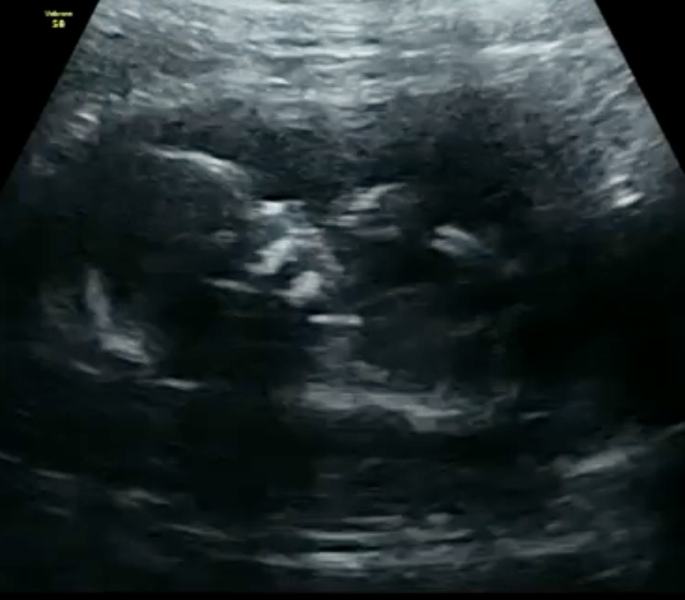 Gender prediction 12 weeks