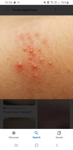 Rash.
