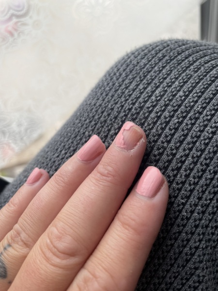 Line on nail skin c advice