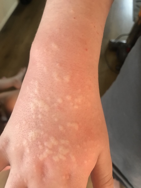 12 year olds skin