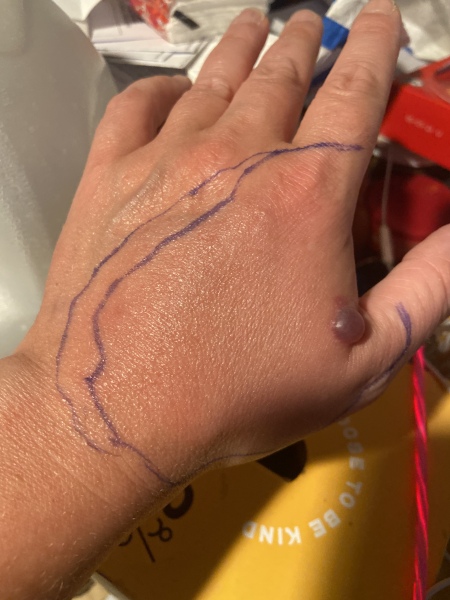 Bite, red/purple blister and swelling/nurses 