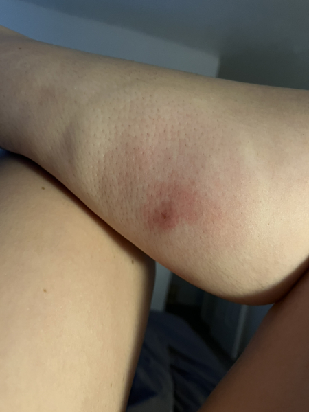 Bug bite - should I be worried???