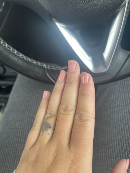 Melanoma scare advice please