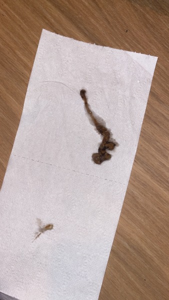 Warning photo! Is this a miscarriage or a big blood clot