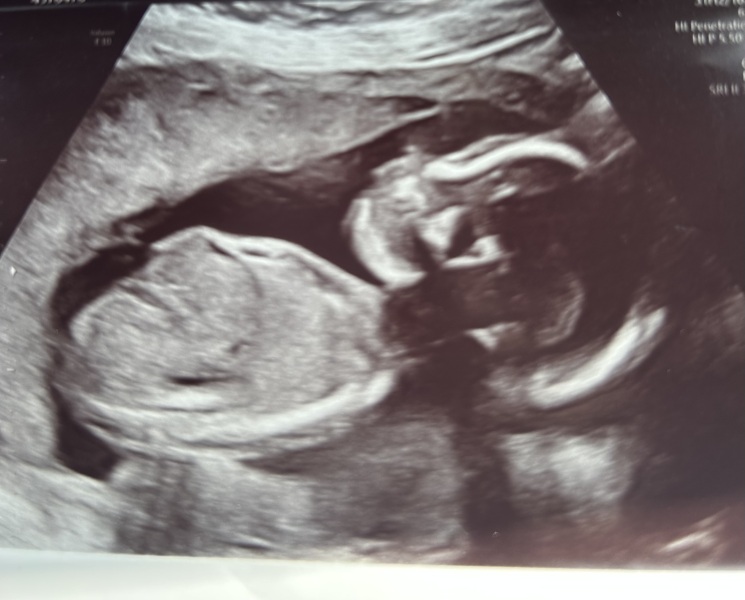 First cycle - IVF / ICSI - Day 4 