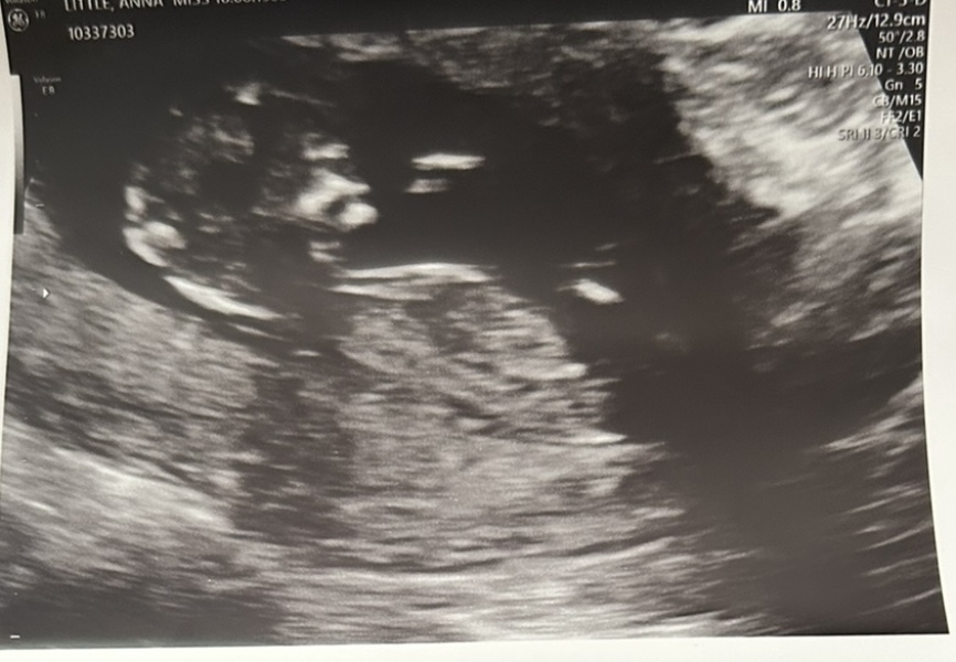 Gender prediction 12 weeks