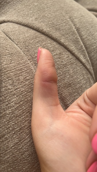 Achenbach syndrome - help, please!