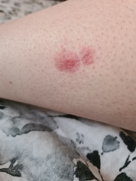 Advice for a bite please